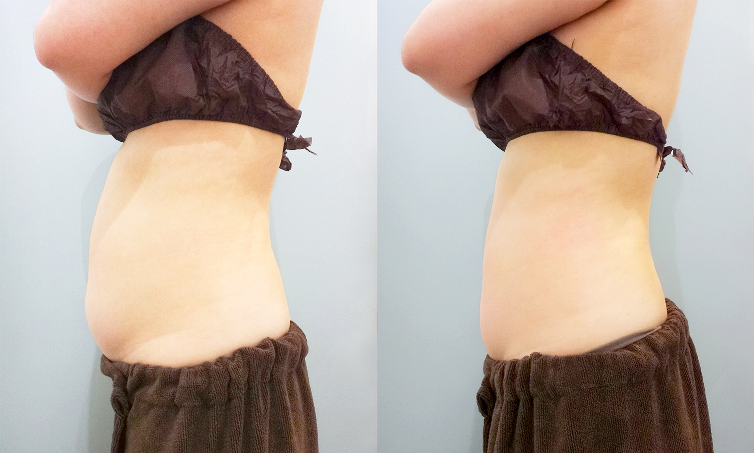 ハイフ×キャビテーション×ラジオ波 ビフォーアフター